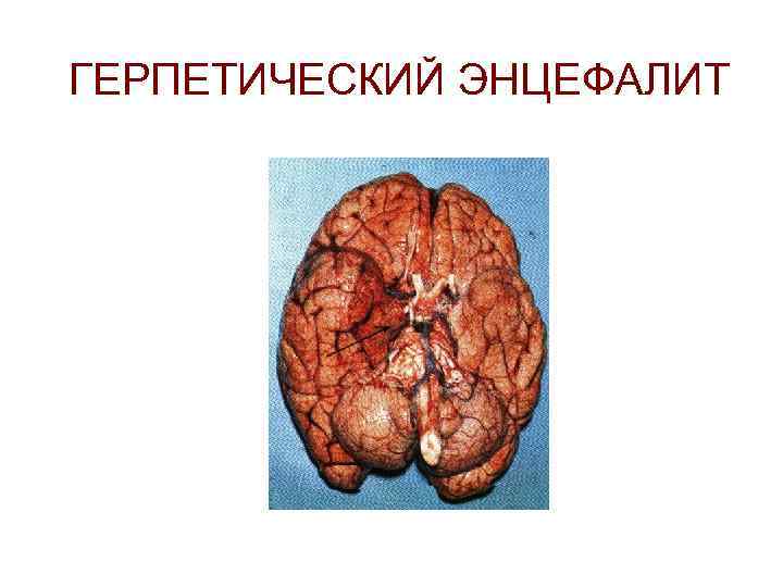 ГЕРПЕТИЧЕСКИЙ ЭНЦЕФАЛИТ 