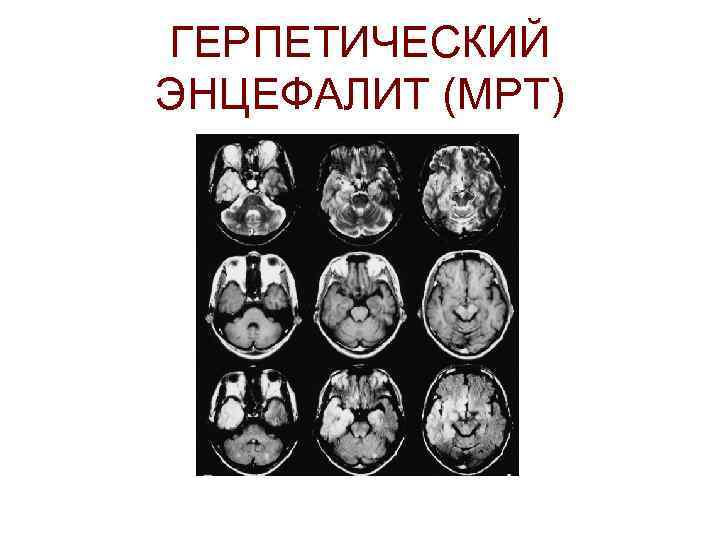 ГЕРПЕТИЧЕСКИЙ ЭНЦЕФАЛИТ (МРТ) 
