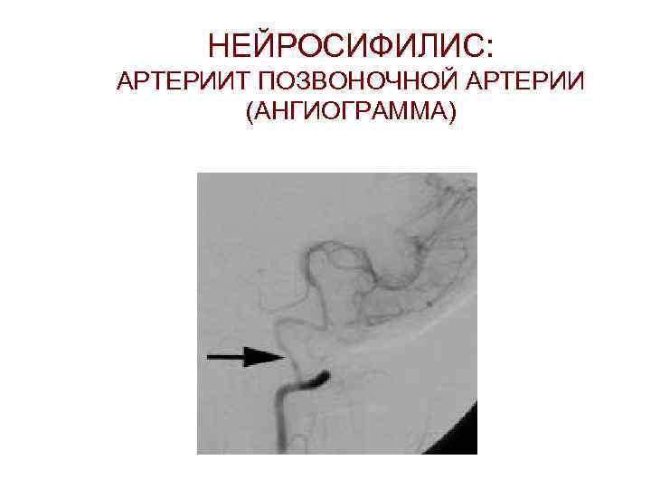 НЕЙРОСИФИЛИС: АРТЕРИИТ ПОЗВОНОЧНОЙ АРТЕРИИ (АНГИОГРАММА) 