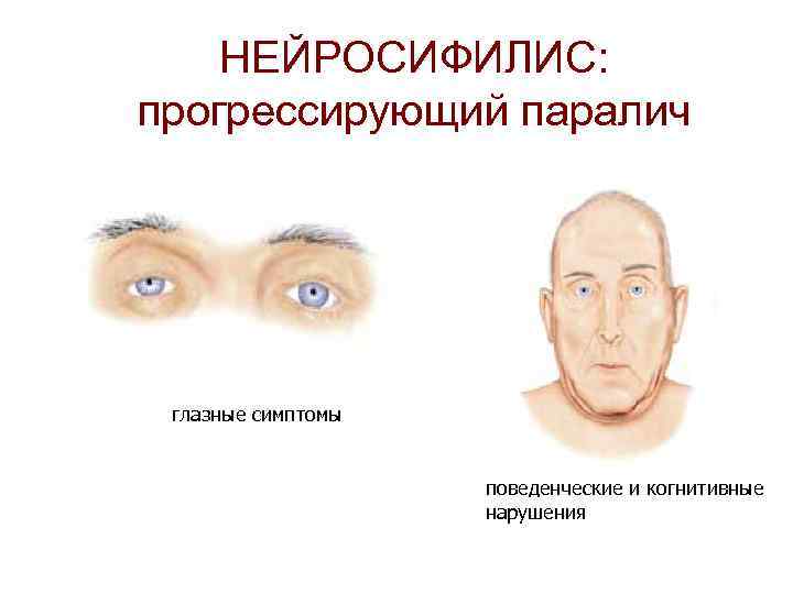 НЕЙРОСИФИЛИС: прогрессирующий паралич глазные симптомы поведенческие и когнитивные нарушения 