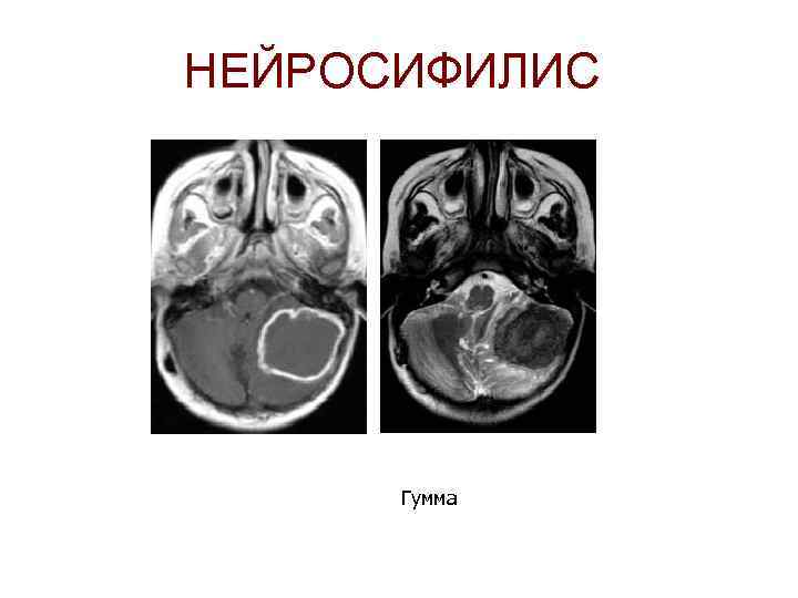НЕЙРОСИФИЛИС Гумма 