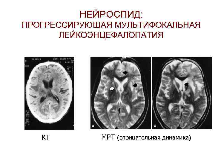 НЕЙРОСПИД: ПРОГРЕССИРУЮЩАЯ МУЛЬТИФОКАЛЬНАЯ ЛЕЙКОЭНЦЕФАЛОПАТИЯ КТ МРТ (отрицательная динамика) 