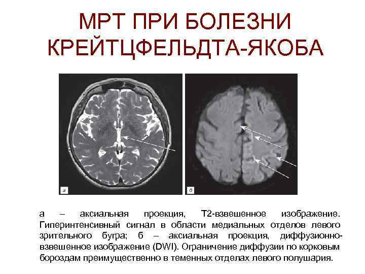МРТ ПРИ БОЛЕЗНИ КРЕЙТЦФЕЛЬДТА-ЯКОБА а – аксиальная проекция, Т 2 -взвешенное изображение. Гиперинтенсивный сигнал