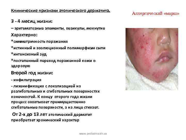Клинические признаки атопического дерматита. 3 - 4 месяц жизни: – эритематозные элементы, везикулы, мокнутие