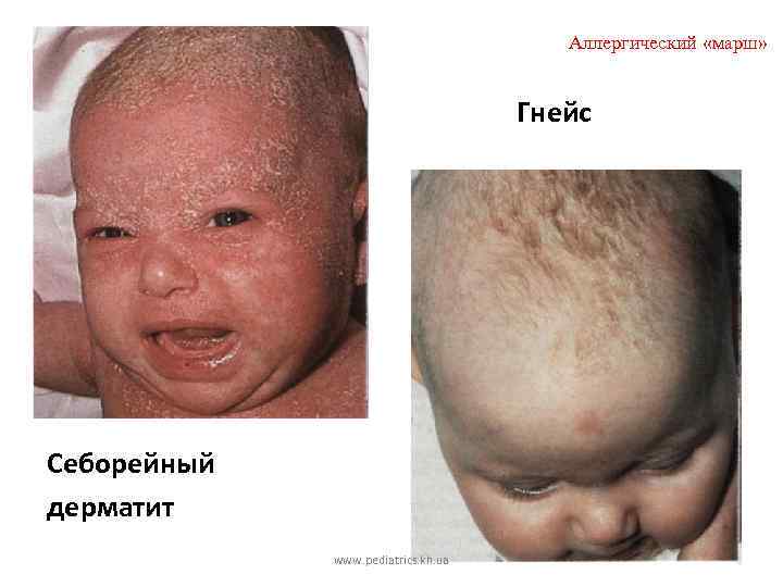 Аллергический «марш» Гнейс Себорейный дерматит www. pediatrics. kh. ua 