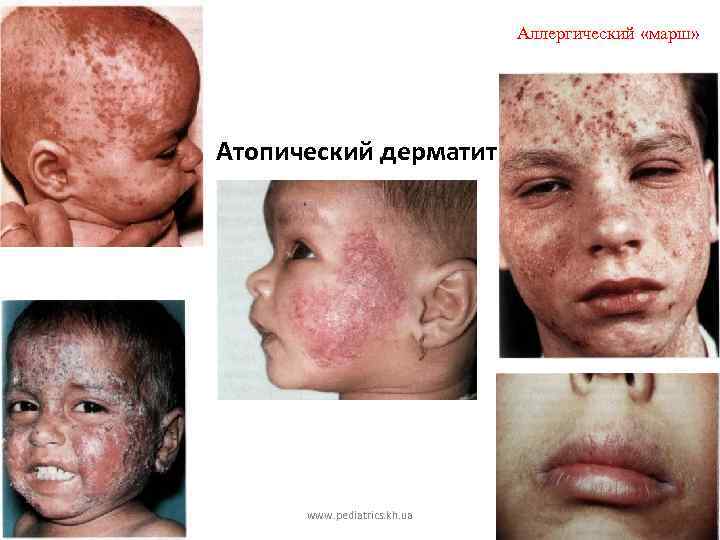 Аллергический «марш» Атопический дерматит www. pediatrics. kh. ua 