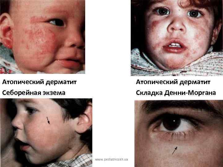 Атопический дерматит Себорейная экзема Атопический дерматит Складка Денни-Моргана www. pediatrics. kh. ua 