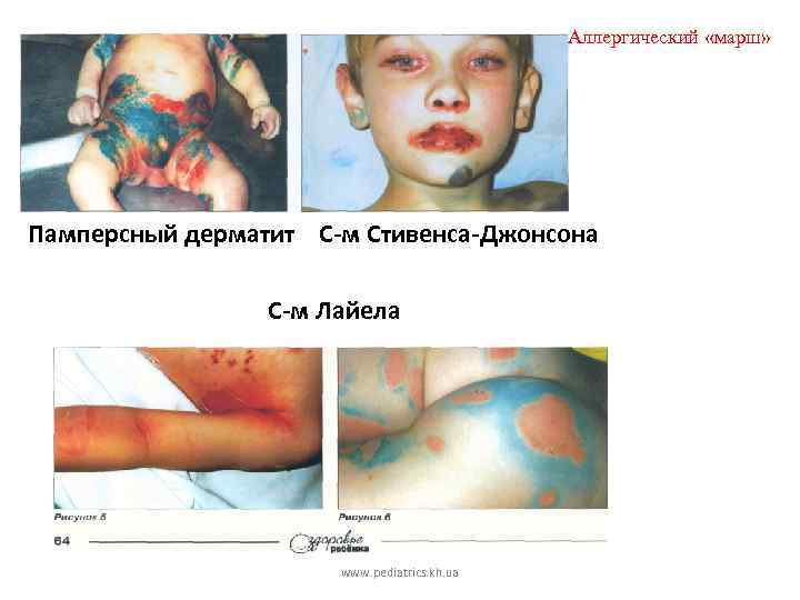 Аллергический «марш» Памперсный дерматит С-м Стивенса-Джонсона С-м Лайела www. pediatrics. kh. ua 
