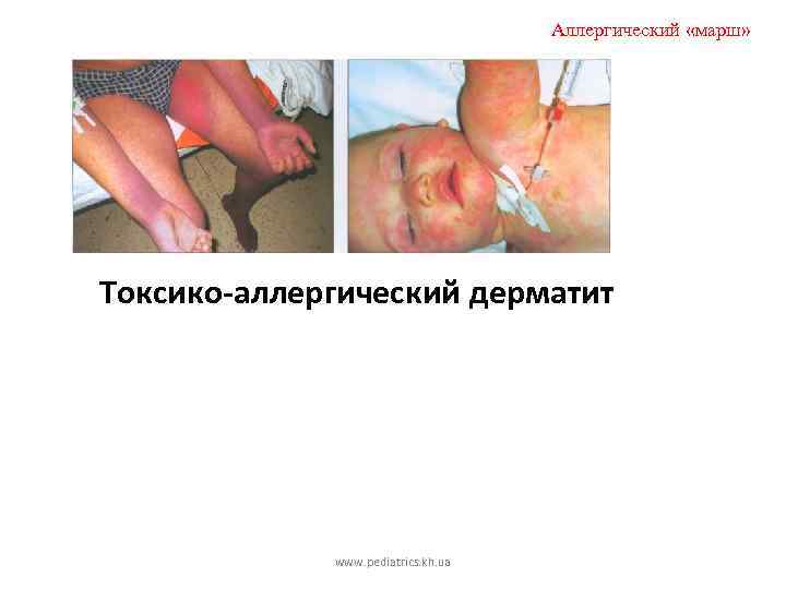 Аллергический «марш» Токсико-аллергический дерматит www. pediatrics. kh. ua 