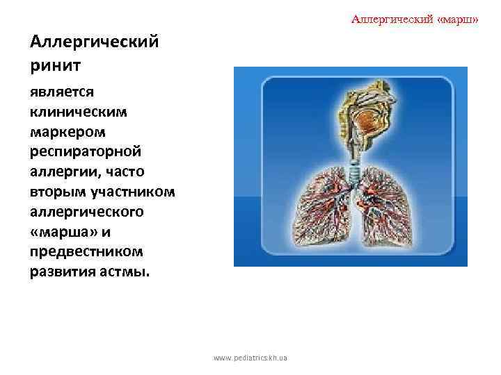 Аллергический «марш» Аллергический ринит является клиническим маркером респираторной аллергии, часто вторым участником аллергического «марша»