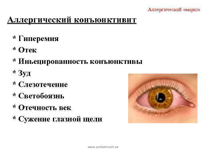 Аллергический «марш» Аллергический конъюнктивит * Гиперемия * Отек * Иньецированность конъюнктивы * Зуд *