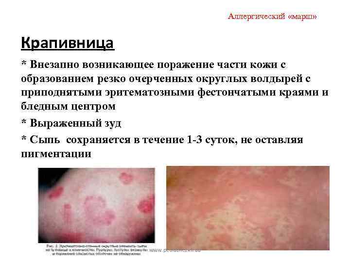 Аллергический «марш» Крапивница * Внезапно возникающее поражение части кожи с образованием резко очерченных округлых