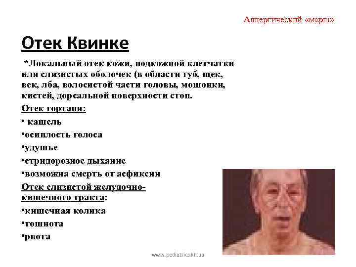 Аллергический «марш» Отек Квинке *Локальный отек кожи, подкожной клетчатки или слизистых оболочек (в области