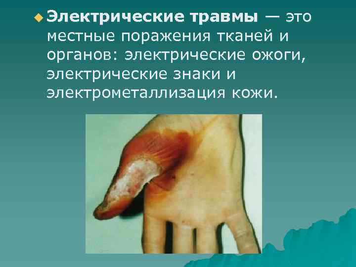 u Электрические травмы — это местные поражения тканей и органов: электрические ожоги, электрические знаки