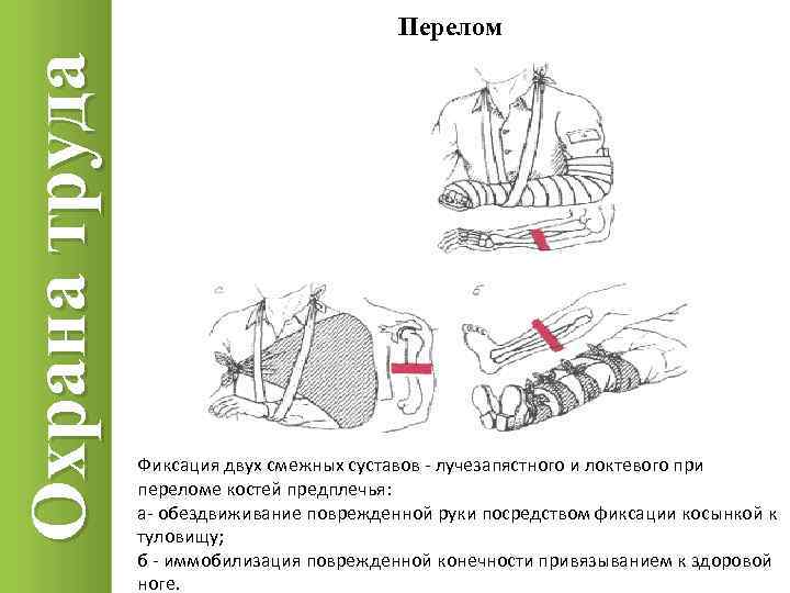 Охрана труда Перелом Фиксация двух смежных суставов - лучезапястного и локтевого при переломе костей