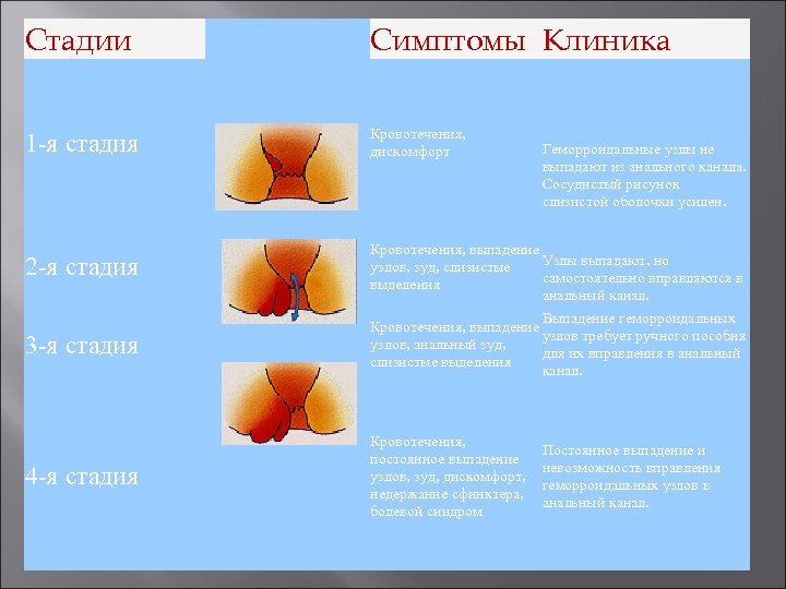 Стадии Симптомы Клиника 1 -я стадия Кровотечения, дискомфорт 2 -я стадия Кровотечения, выпадение Узлы