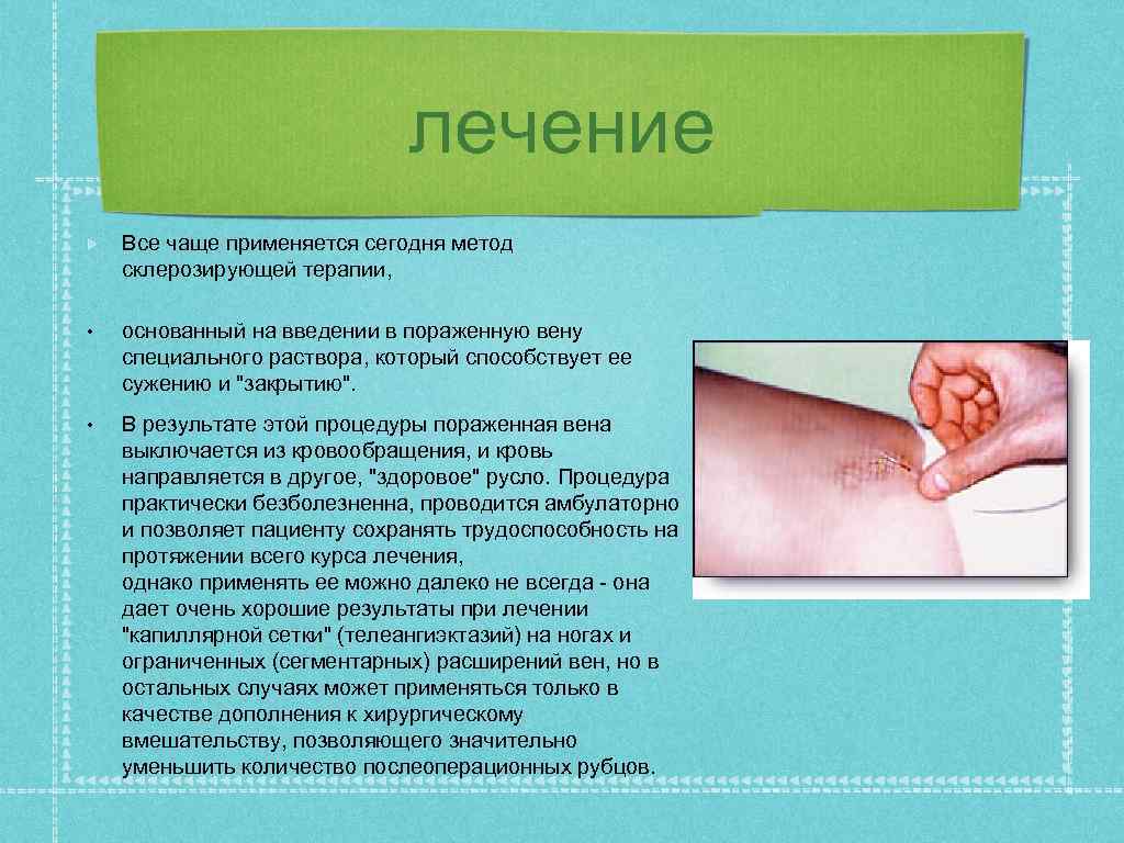 лечение Все чаще применяется сегодня метод склерозирующей терапии, • основанный на введении в пораженную