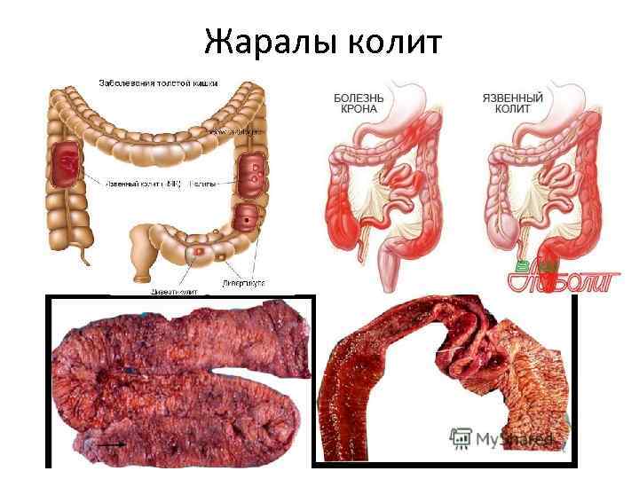 Жаралы колит 