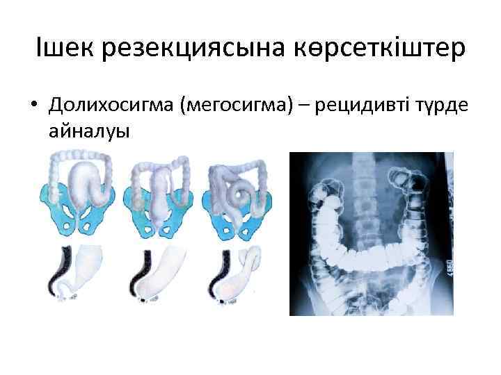 Ішек резекциясына көрсеткіштер • Долихосигма (мегосигма) – рецидивті түрде айналуы 