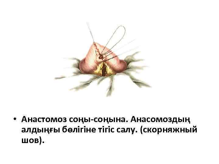  • Анастомоз соңы-соңына. Анасомоздың алдыңғы бөлігіне тігіс салу. (скорняжный шов). 