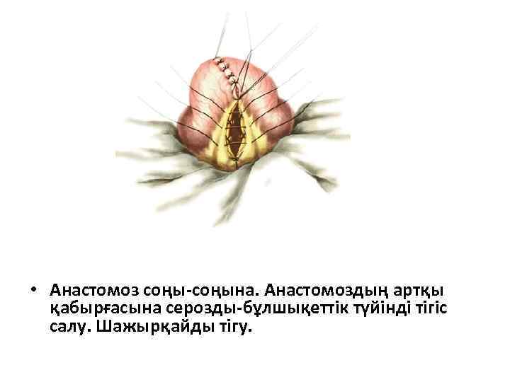  • Анастомоз соңы-соңына. Анастомоздың артқы қабырғасына серозды-бұлшықеттік түйінді тігіс салу. Шажырқайды тігу. 