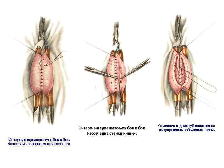 Энтеро-энтероанастомоз бок в бок. Рассечение стенки кишки. Энтеро-энтероанастомоз бок в бок. Наложение серозно-мышечного шва.