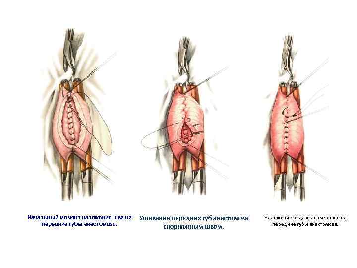 Начальный момент наложения шва на передние губы анастомоза. Ушивание передних губ анастомоза скорняжным швом.