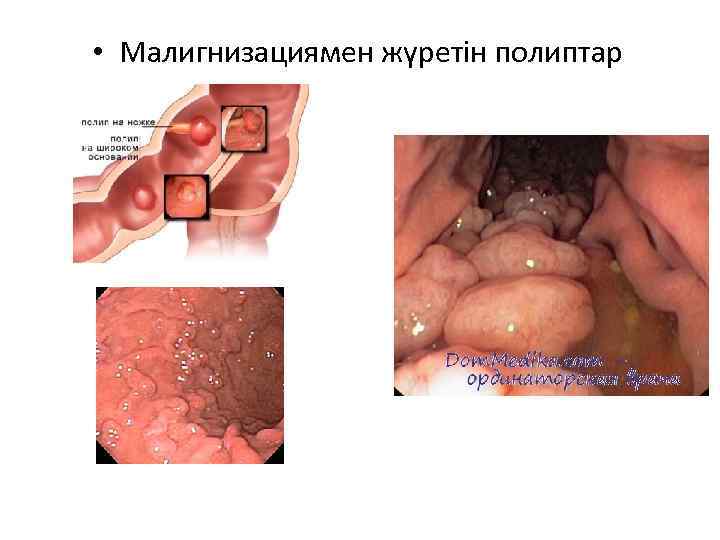  • Малигнизациямен жүретін полиптар 