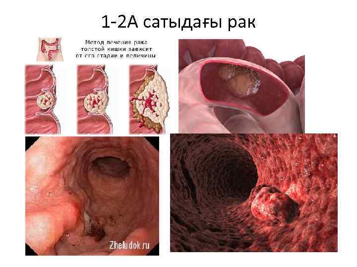 1 -2 А сатыдағы рак 