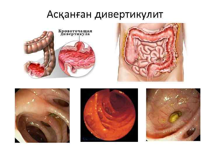 Асқанған дивертикулит 