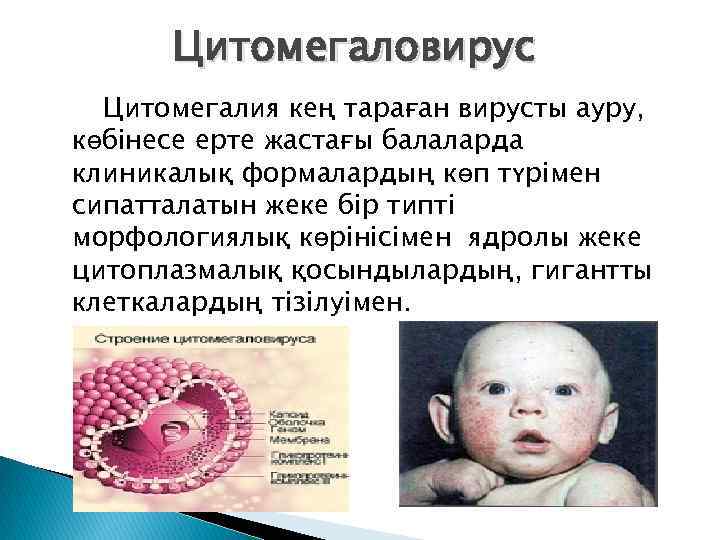 Цитомегаловирус Цитомегалия кең тараған вирусты ауру, көбінесе ерте жастағы балаларда клиникалық формалардың көп түрімен