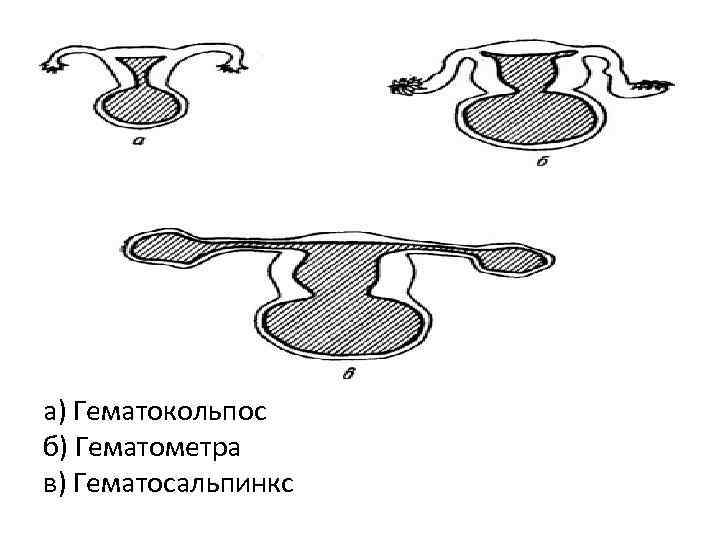 a) Гематокольпос б) Гематометра в) Гематосальпинкс 