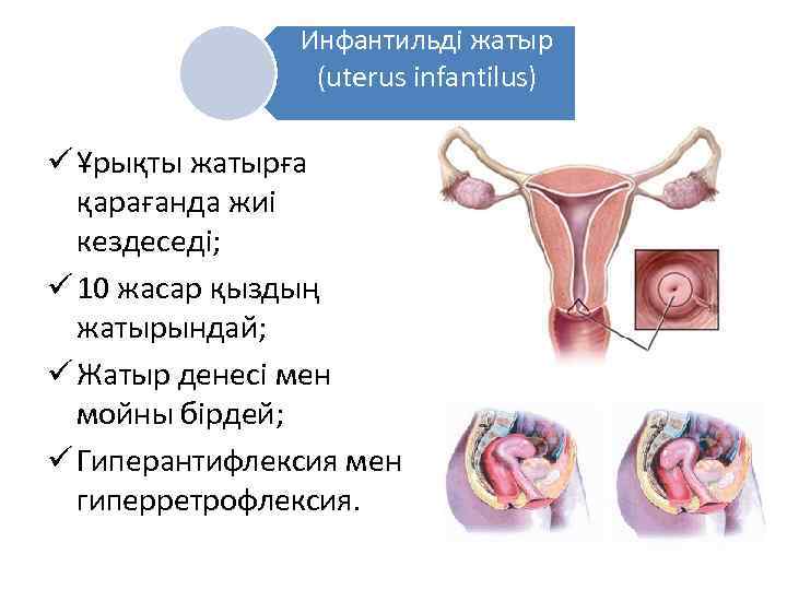 Инфантильді жатыр (uterus infantilus) ü Ұрықты жатырға қарағанда жиі кездеседі; ü 10 жасар қыздың