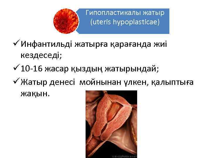 Гипопластикалы жатыр (uteris hypoplasticae) ü Инфантильді жатырға қарағанда жиі кездеседі; ü 10 -16 жасар