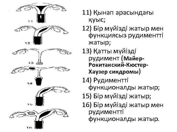 11) Қынап арасындағы қуыс; 12) Бір мүйізді жатыр мен функциясыз рудиментті жатыр; 13) Қатты