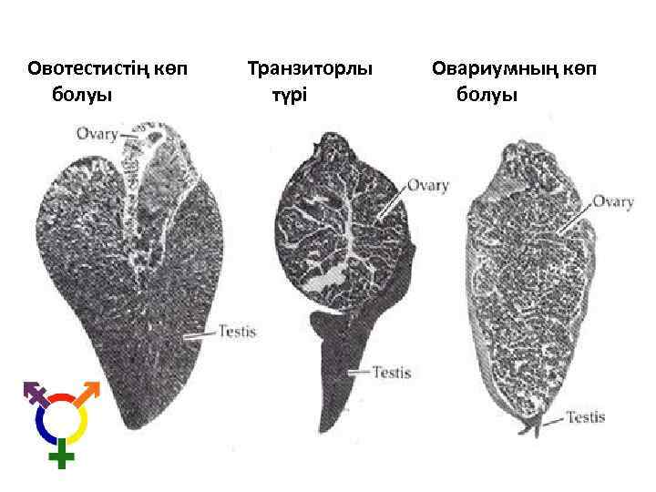 Овотестистің көп болуы Транзиторлы түрі Овариумның көп болуы 