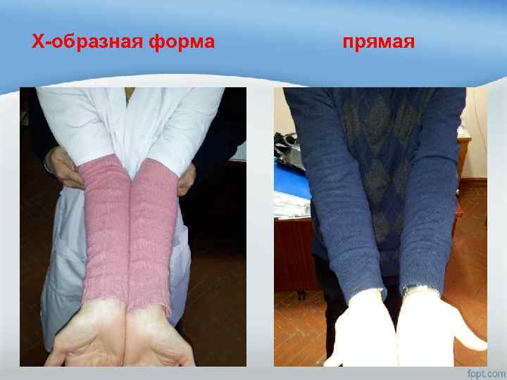 Х-образная форма прямая 