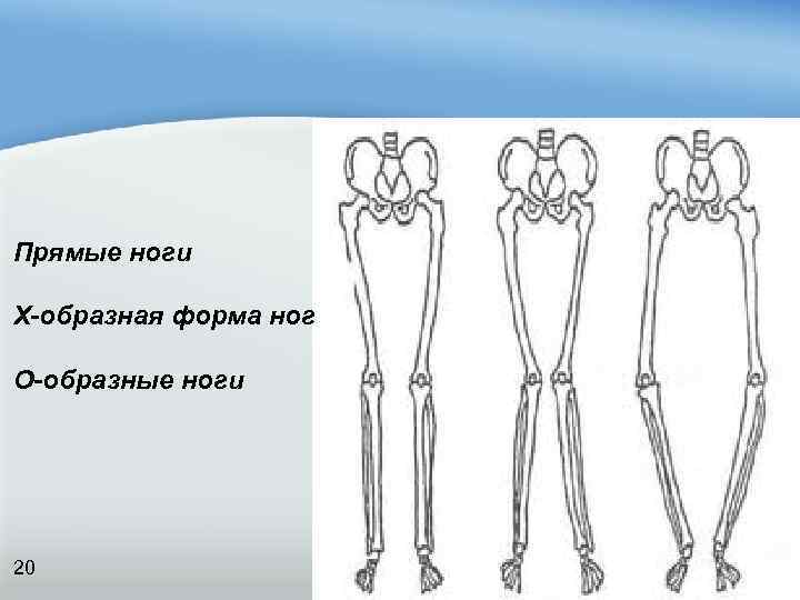 Прямые ноги Х-образная форма ног О-образные ноги 20 