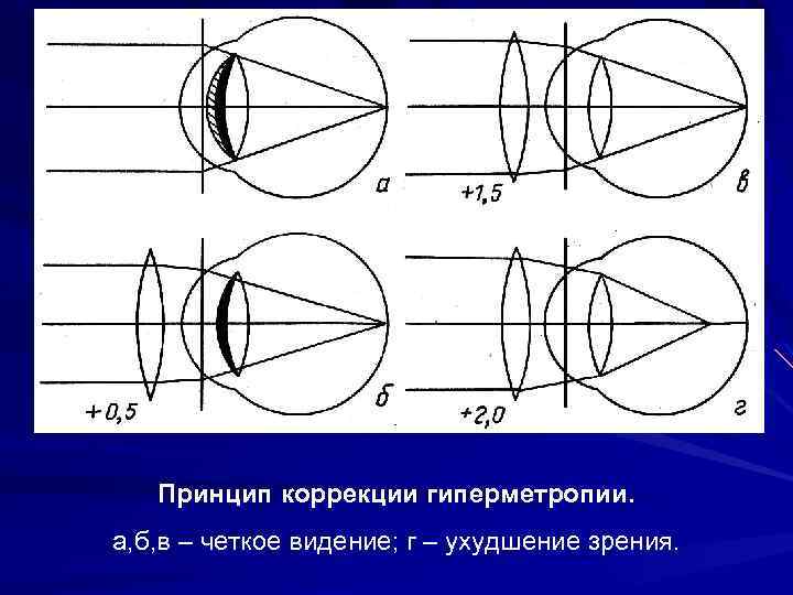 Принцип коррекции гиперметропии. а, б, в – четкое видение; г – ухудшение зрения. 