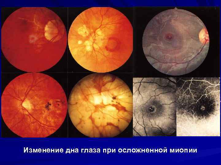 Изменение дна глаза при осложненной миопии 