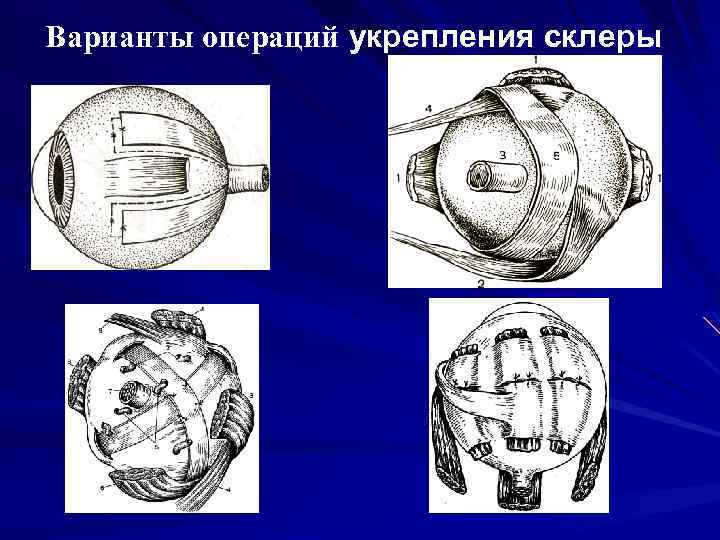 Варианты операций укрепления склеры 
