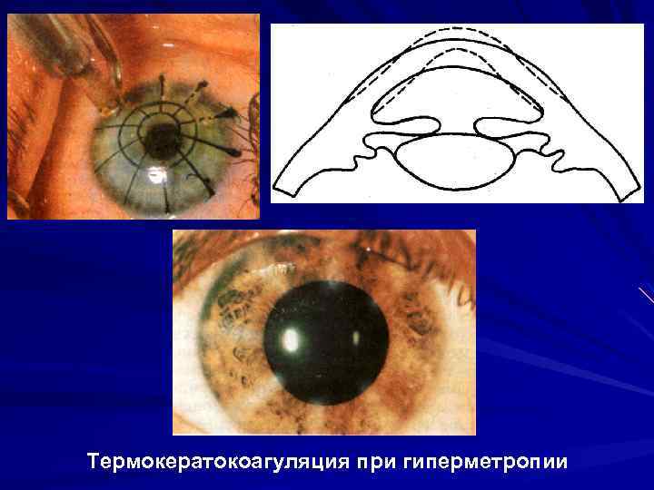Термокератокоагуляция при гиперметропии 