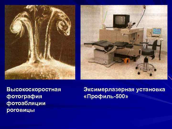 Высокоскоростная фотография фотоабляции роговицы Эксимерлазерная установка «Профиль-500» 
