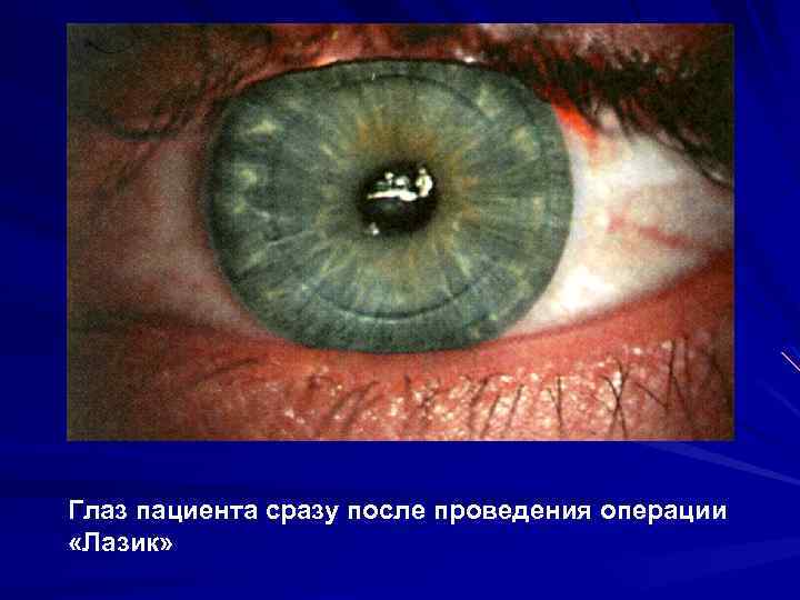Глаз пациента сразу после проведения операции «Лазик» 
