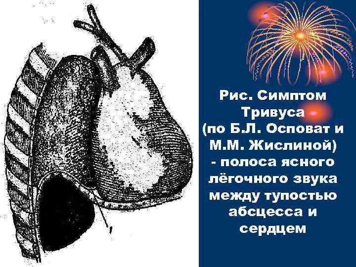 Рис. Симптом Тривуса (по Б. Л. Осповат и М. М. Жислиной) - полоса ясного