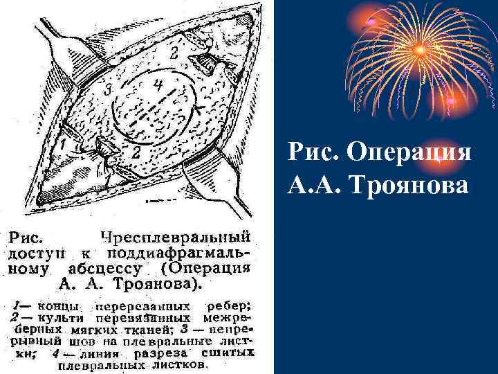 Рис. Операция А. А. Троянова 