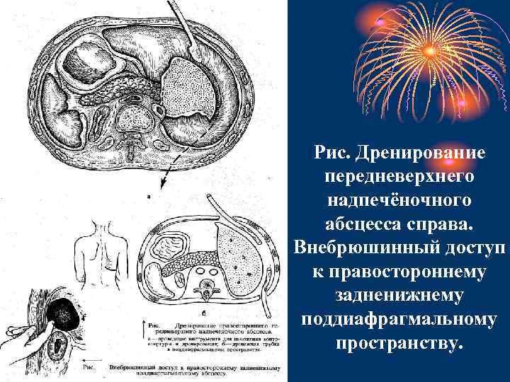 Рис. Дренирование передневерхнего надпечёночного абсцесса справа. Внебрюшинный доступ к правостороннему задненижнему поддиафрагмальному пространству. 