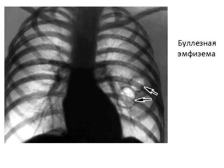 Буллезная эмфизема 