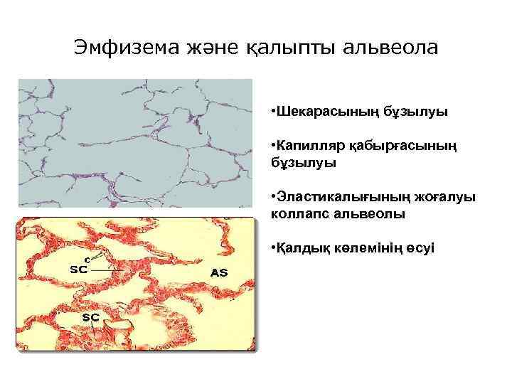 Эмфизема және қалыпты альвеола • Шекарасының бұзылуы • Капилляр қабырғасының бұзылуы • Эластикалығының жоғалуы