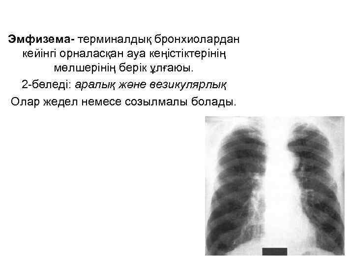 Эмфизема- терминалдық бронхиолардан кейінгі орналасқан ауа кеңістіктерінің мөлшерінің берік ұлғаюы. 2 -бөледі: аралық және